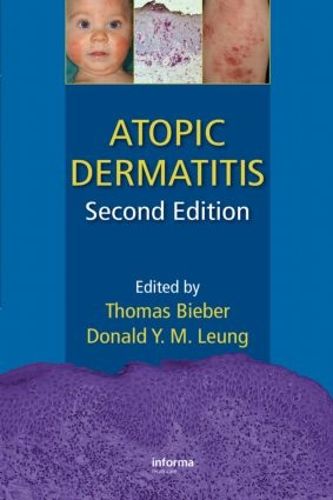 Cover image for Atopic Dermatitis