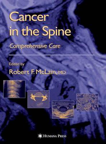 Cancer in the Spine: Comprehensive Care