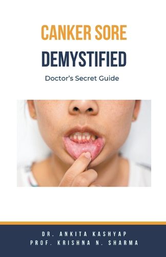 Canker Sore Demystified