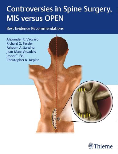 Cover image for Controversies in Spine Surgery, MIS versus OPEN: Best Evidence Recommendations