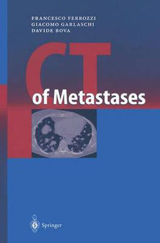 Cover image for CT of Metastases