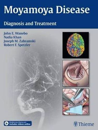 Cover image for Moyamoya Disease: Diagnosis and Treatment